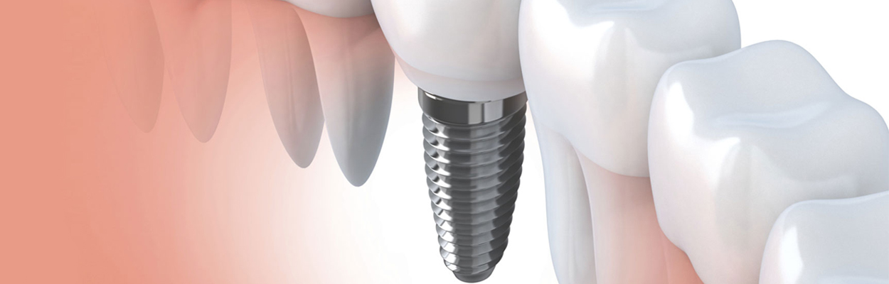 Dental Implants in Pitampura and Rajouri Garden